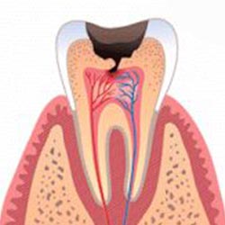 cavity-3 cavity-3