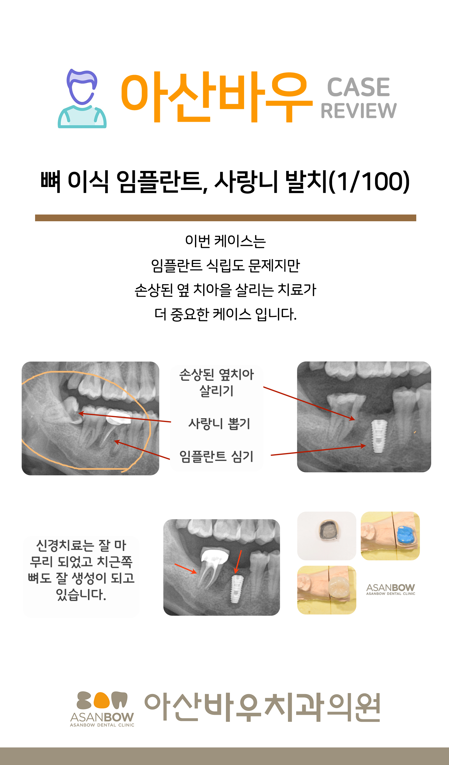 (1/100) 뼈 이식 임플란트, 사랑니 발치